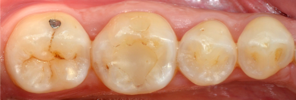 denti cone carie e otturazioni vecchie